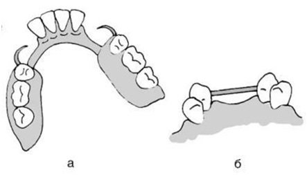 Акриловые зубные протезы что это такое